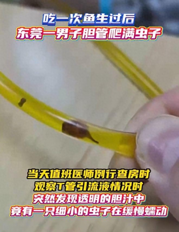 子吃鱼生后胆管爬满肝吸虫麻将胡了app医