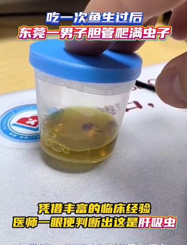 子吃鱼生后胆管爬满肝吸虫麻将胡了app医生回应男(图3) 子吃鱼生后胆管爬满肝吸虫麻将胡了app医生回应男(图3)